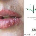 🦠 Herpes – der unsichtbare Dauergast