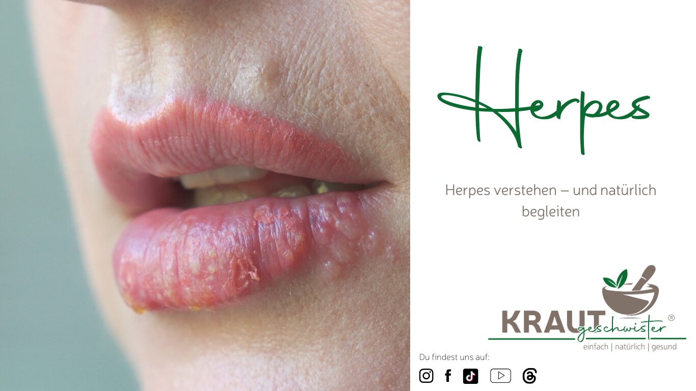 Mehr über den Artikel erfahren 🦠 Herpes – der unsichtbare Dauergast