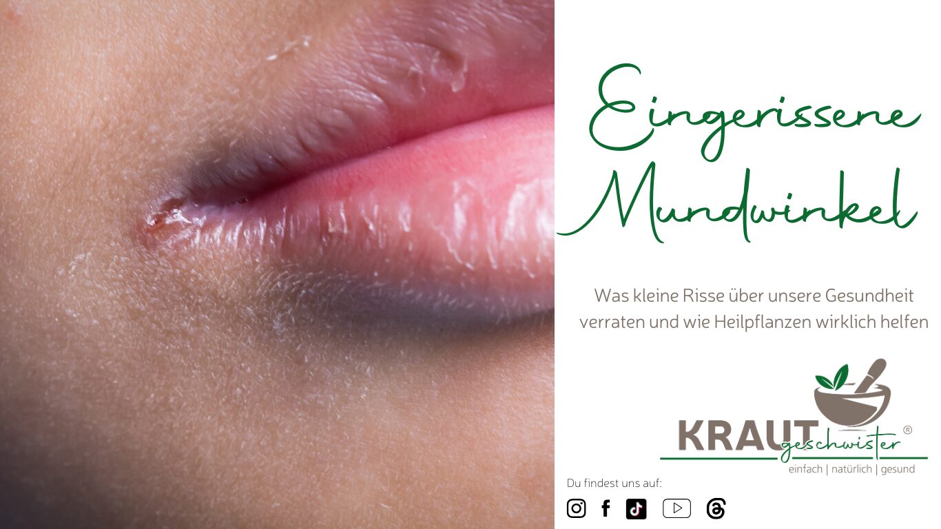 Mehr über den Artikel erfahren Eingerissene Mundwinkel