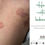 Hautpilz natürlich bekämpfen
