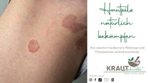 Hautpilz nat&uuml;rlich bek&auml;mpfen