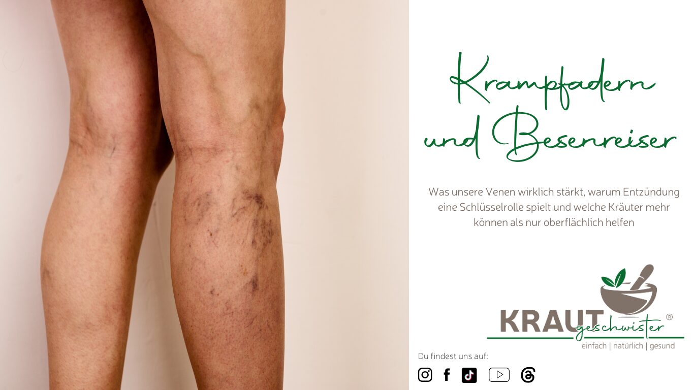 Mehr über den Artikel erfahren Krampfadern und Besenreiser