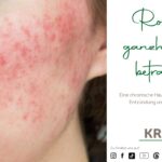 Rosacea ganzheitlich betrachtet