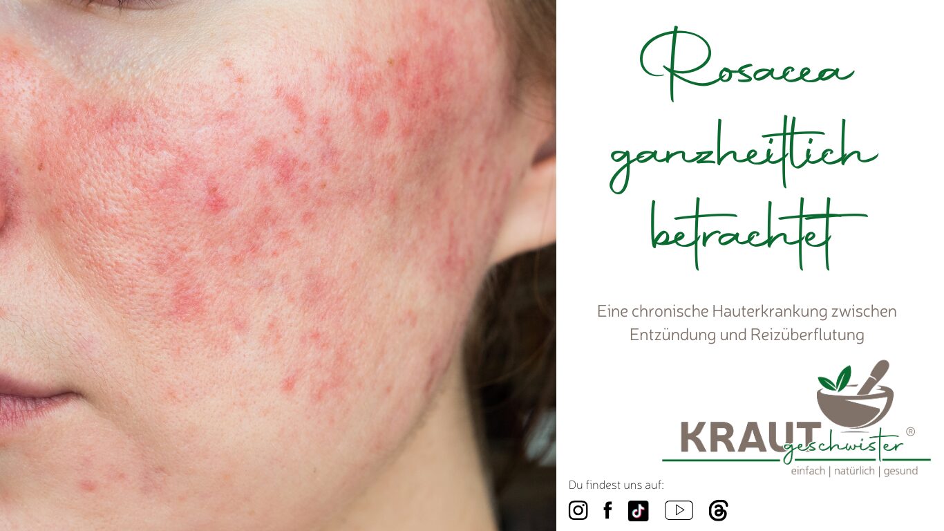 Rosacea ganzheitlich betrachtet
