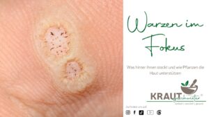 Warzen im Fokus