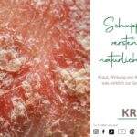 Schuppenflechte verstehen und natürlich begleiten