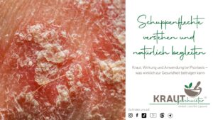 Schuppenflechte verstehen und natürlich begleiten