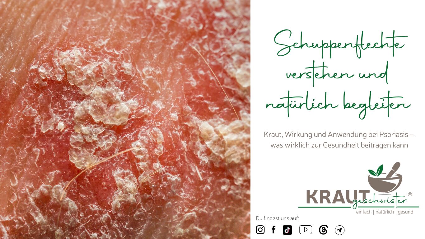 Mehr über den Artikel erfahren Schuppenflechte verstehen und natürlich begleiten