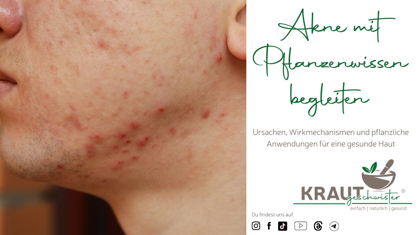 Mehr über den Artikel erfahren Akne mit Pflanzenwissen begleiten