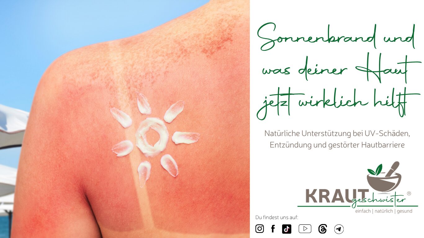 Sonnenbrand und was deiner Haut jetzt wirklich hilft